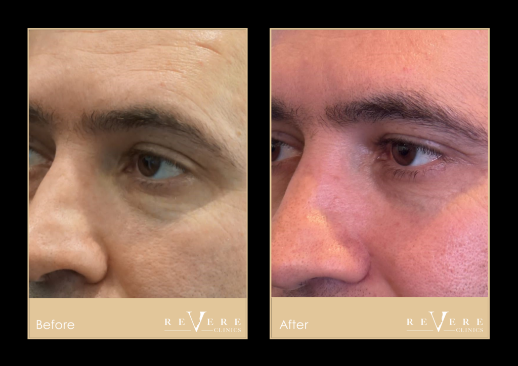 p5 facial results by revere clinics at harley street london