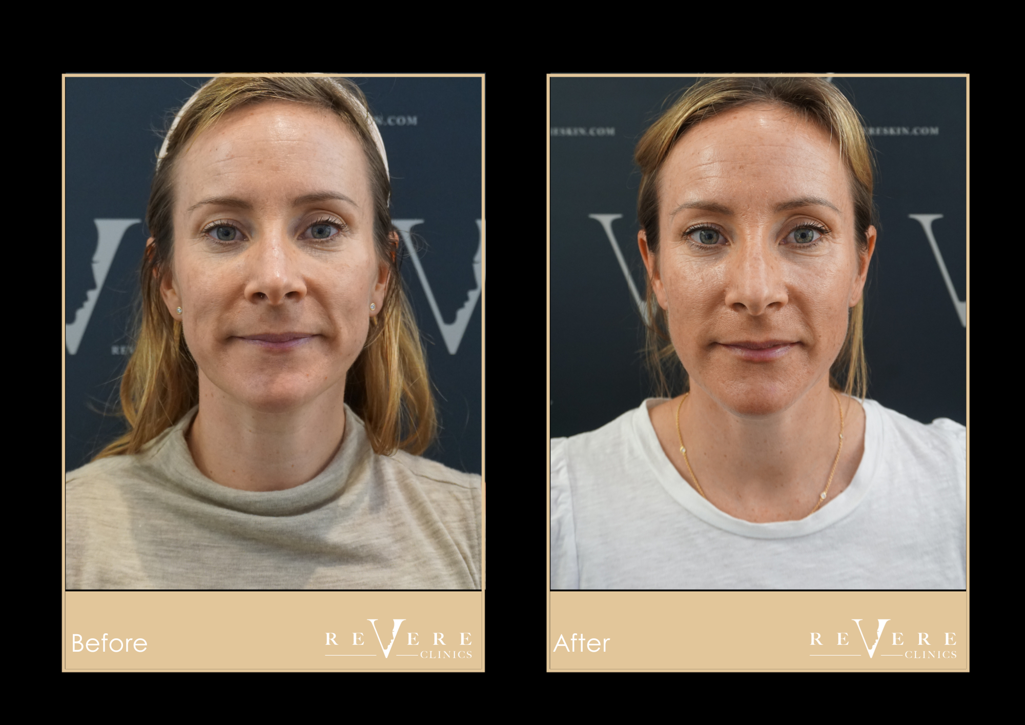 P2-P5 Facial Results
